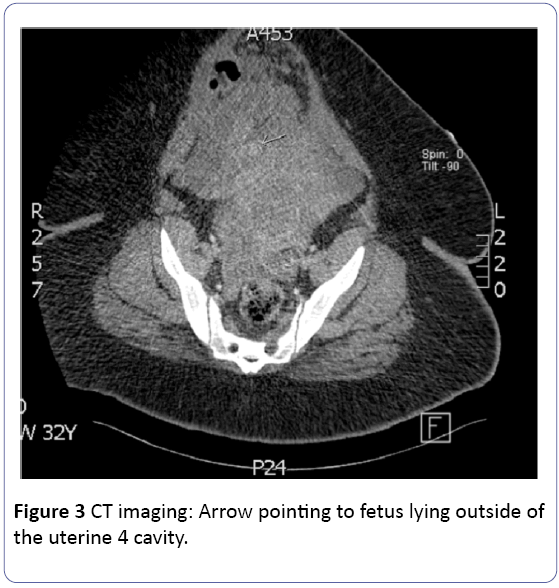 Obstetrics-Gynecology-CT-imaging-Arrow-pointing