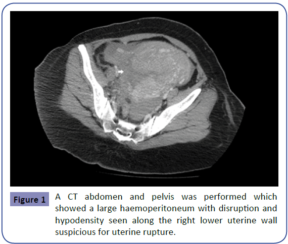 obstetrics-CT-abdomen